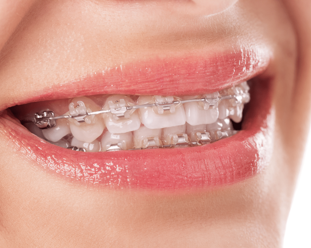 Antalya Diş Teli Tedavisi