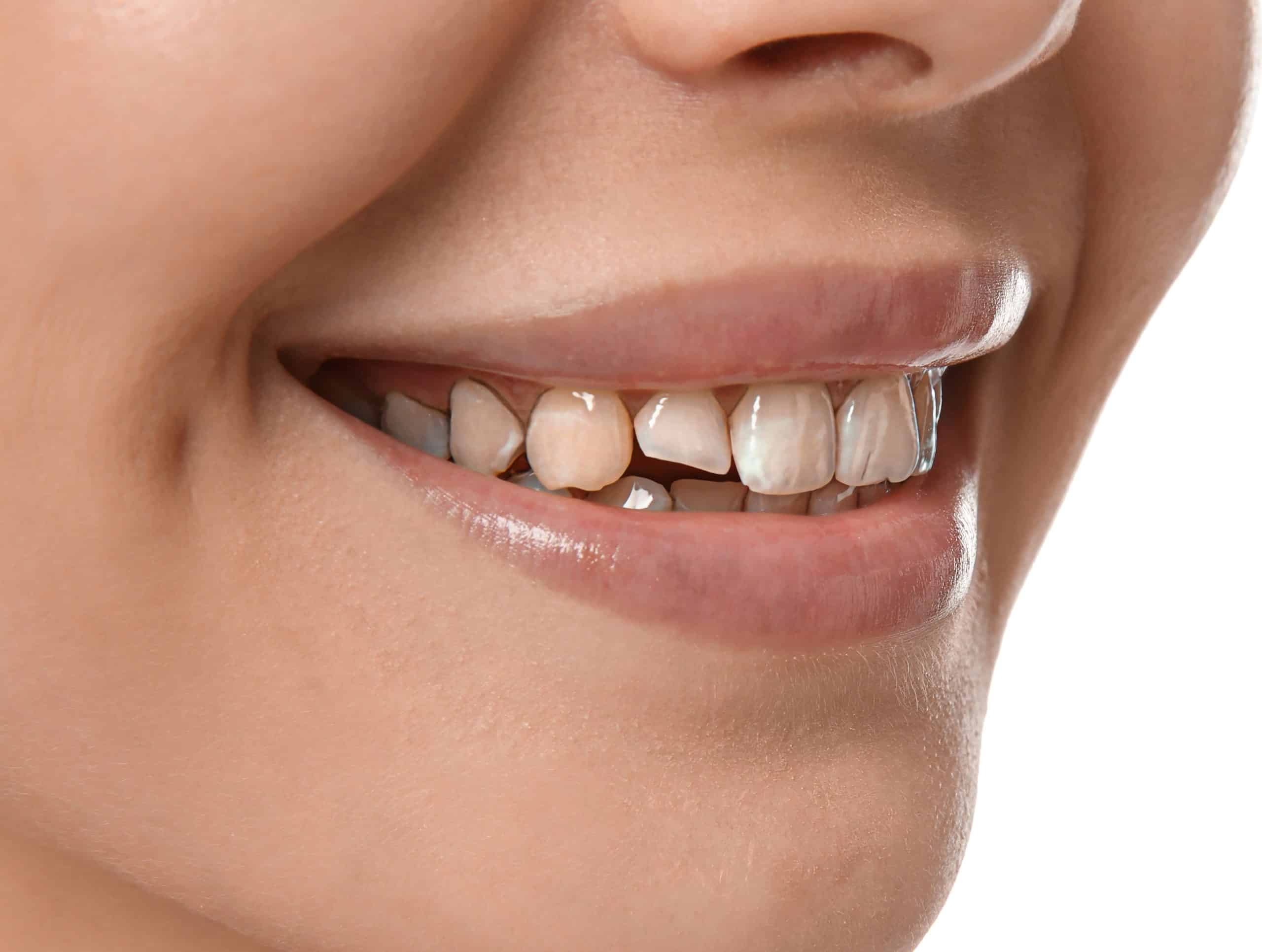 Antalya Diş Estetiği